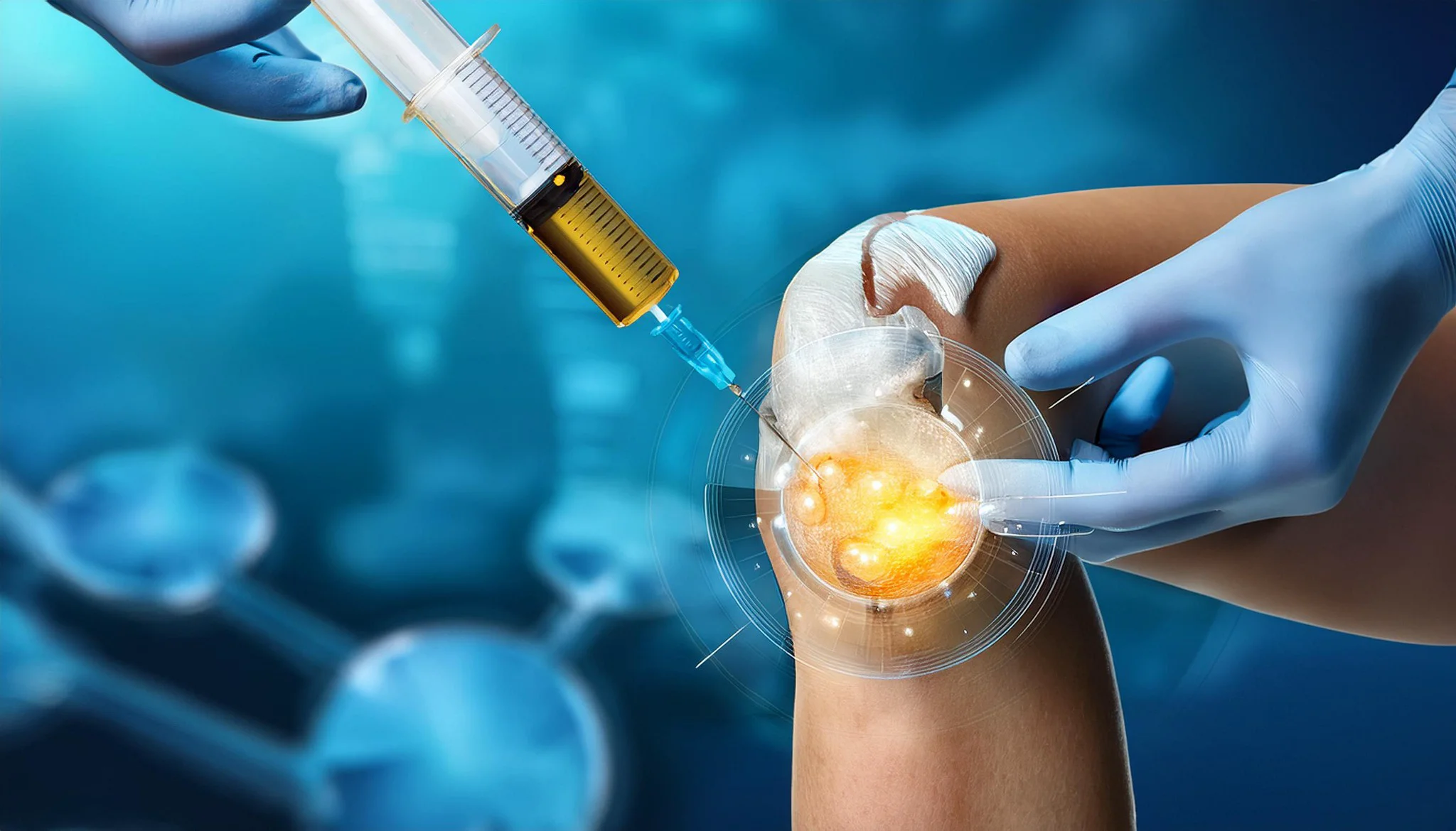 LIỆU PHÁP PRP TRONG ĐIỀU TRỊ CƠ XƯƠNG KHỚP – TỪ VẬN ĐỘNG VIÊN ĐỈNH CAO ĐẾN ỨNG DỤNG LÂM SÀNG